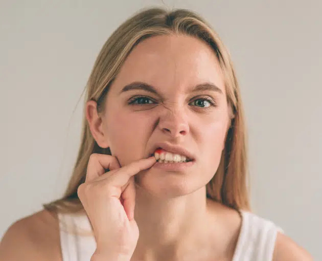 how to prevent bleeding gums