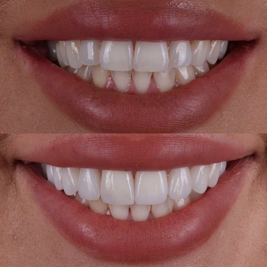 Veneers smile transformation by Dr. Kooper Ruminer