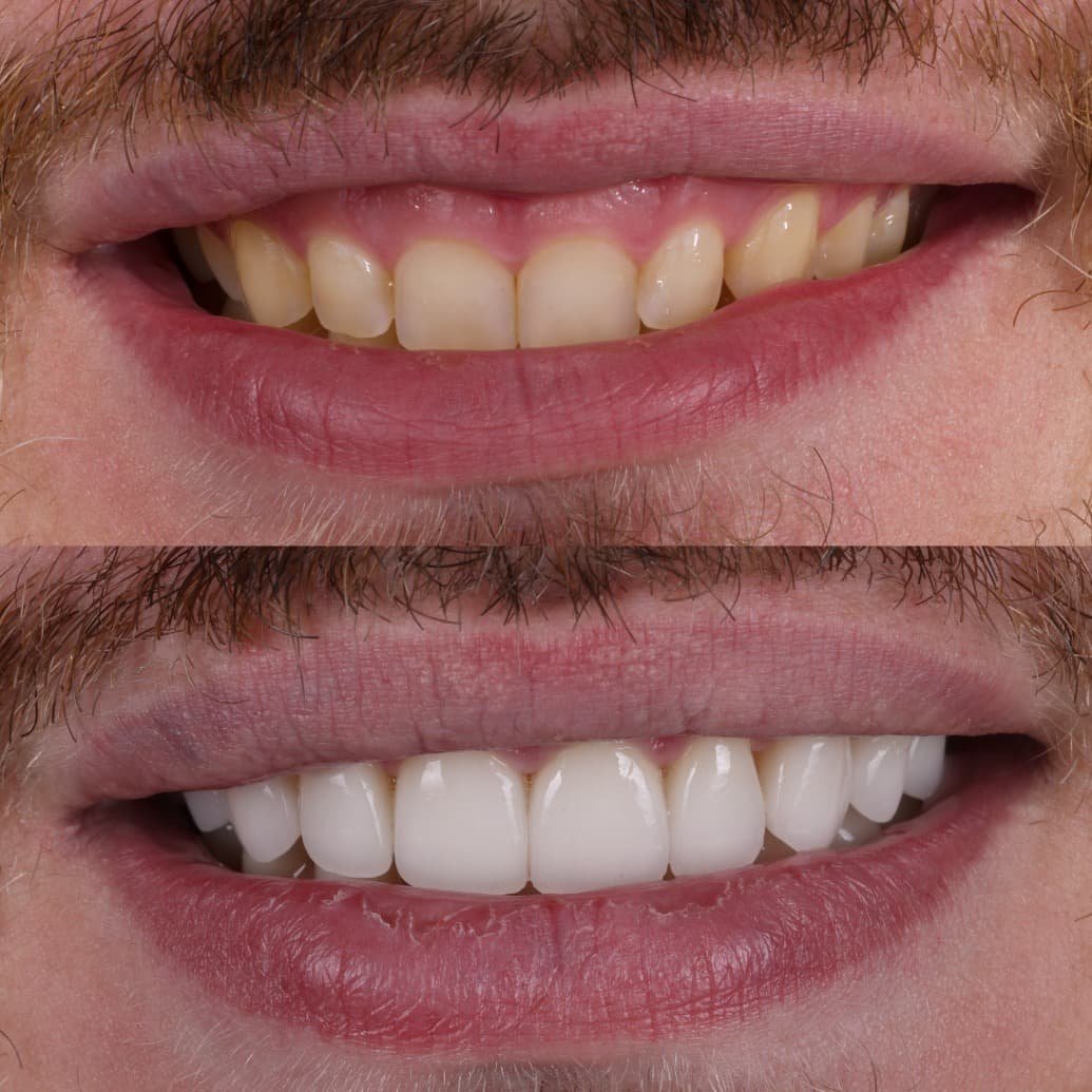 Veneers smile transformation by Dr. Kooper Ruminer