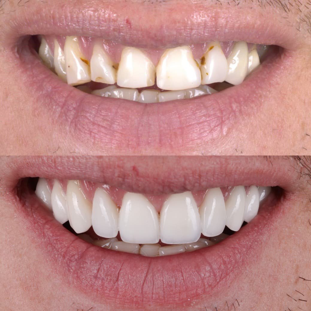 Veneers smile transformation by Dr. Kooper Ruminer