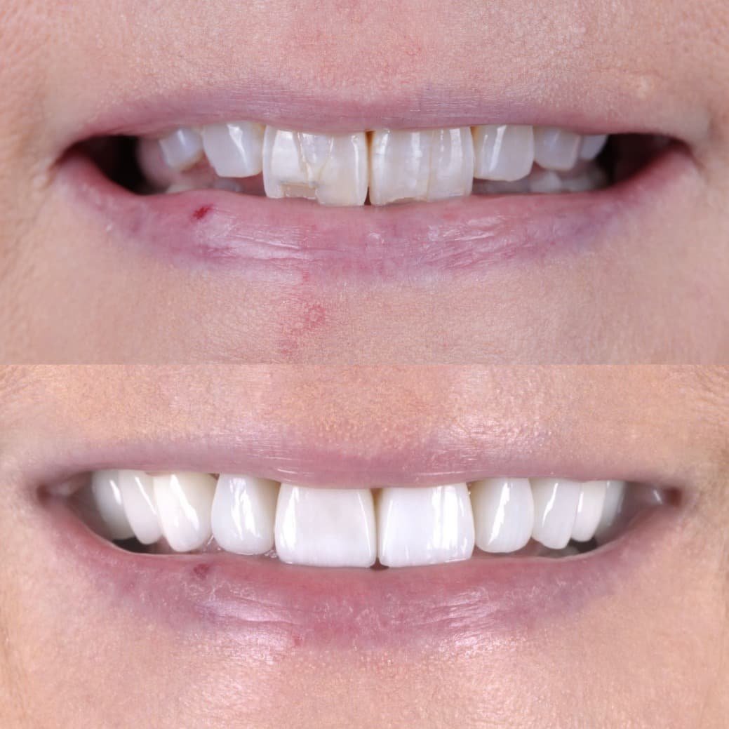 Veneers smile transformation by Dr. Kooper Ruminer