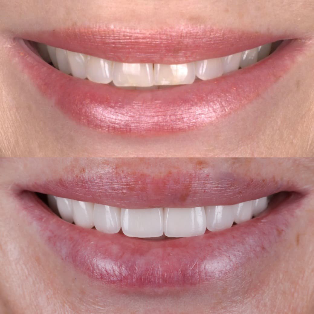 Veneers smile transformation by Dr. Kooper Ruminer