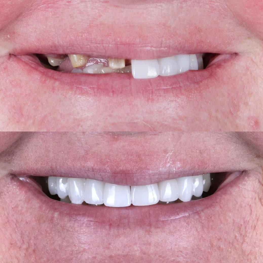 Veneers smile transformation by Dr. Kooper Ruminer