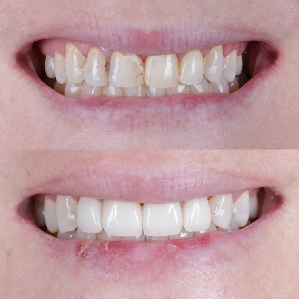 Veneers smile transformation by Dr. Kooper Ruminer