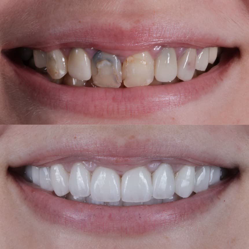 Veneers smile transformation by Dr. Kooper Ruminer