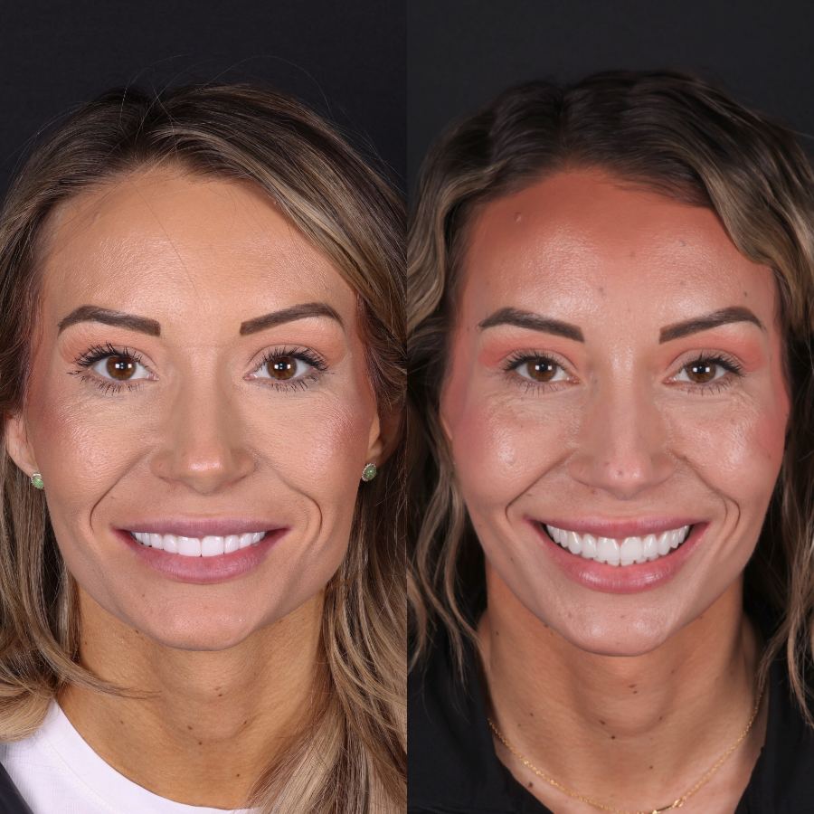After — smile transformation by Dr. Kooper Ruminer