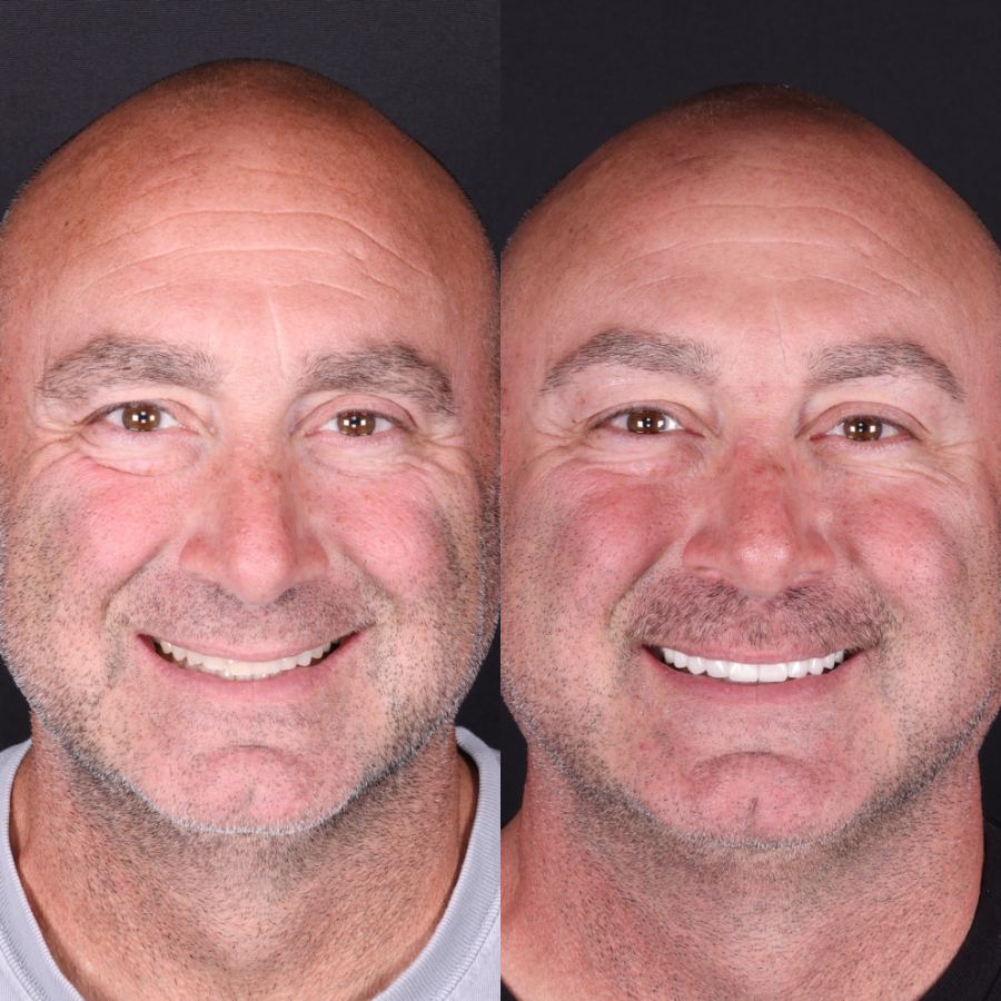 Before — smile transformation by Dr. Kooper Ruminer