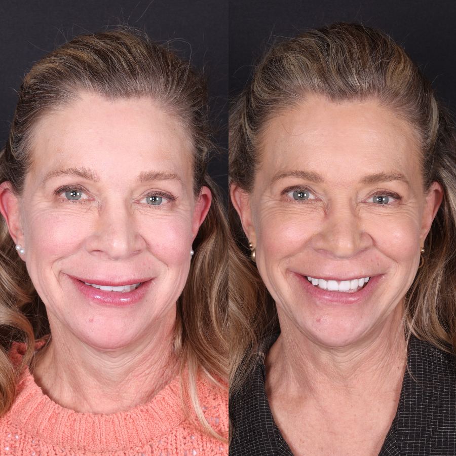 After — smile transformation by Dr. Kooper Ruminer