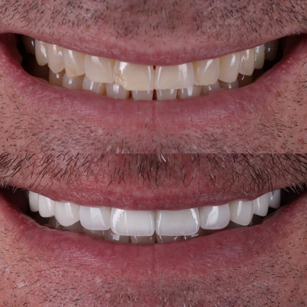 Veneers smile transformation by Dr. Kooper Ruminer