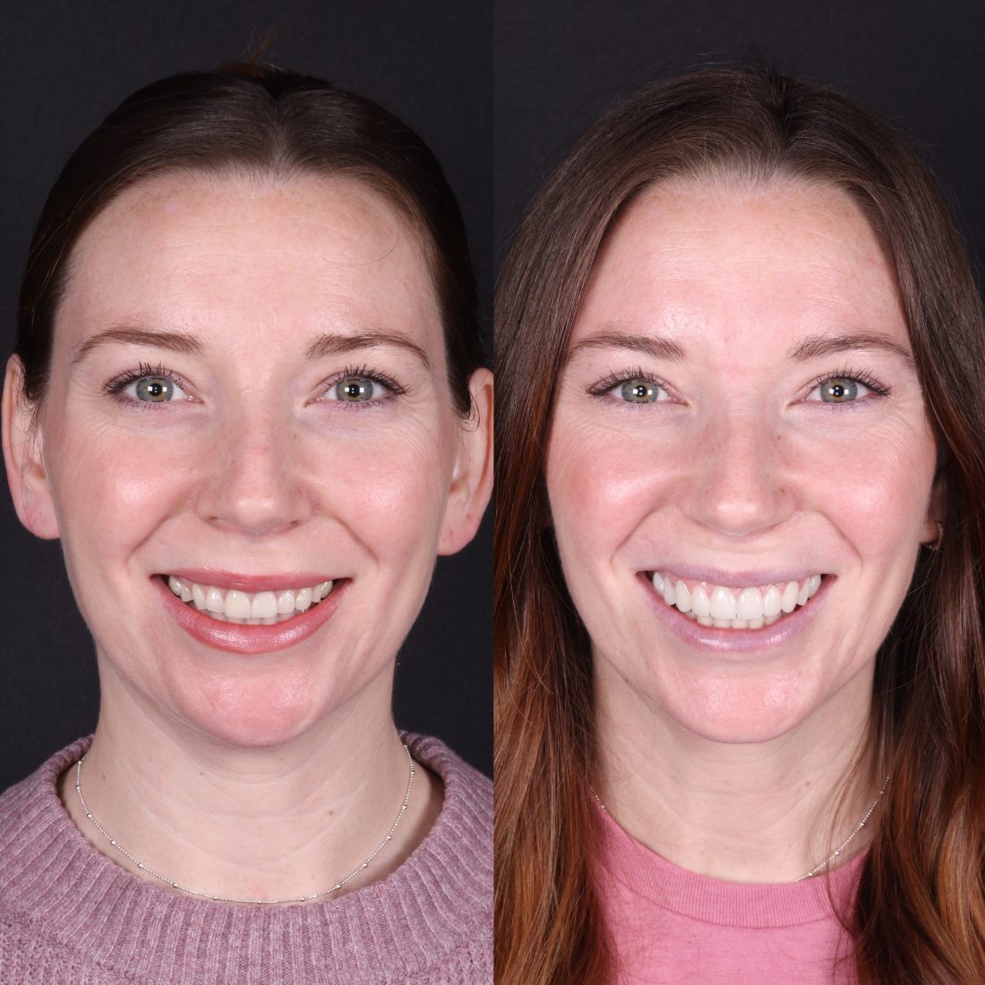 Veneers before and after by Dr. Kooper Ruminer