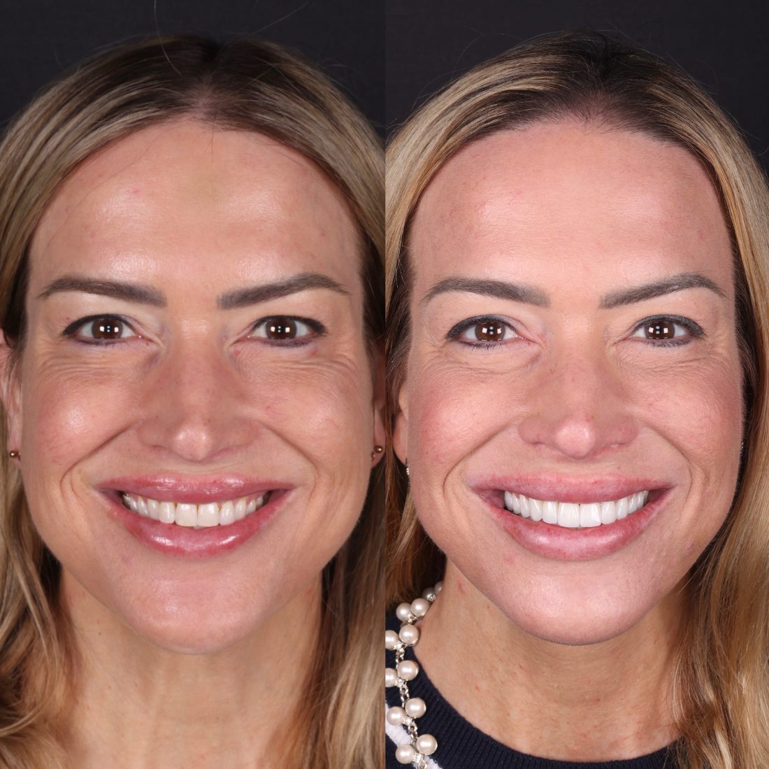 Veneers before and after by Dr. Kooper Ruminer