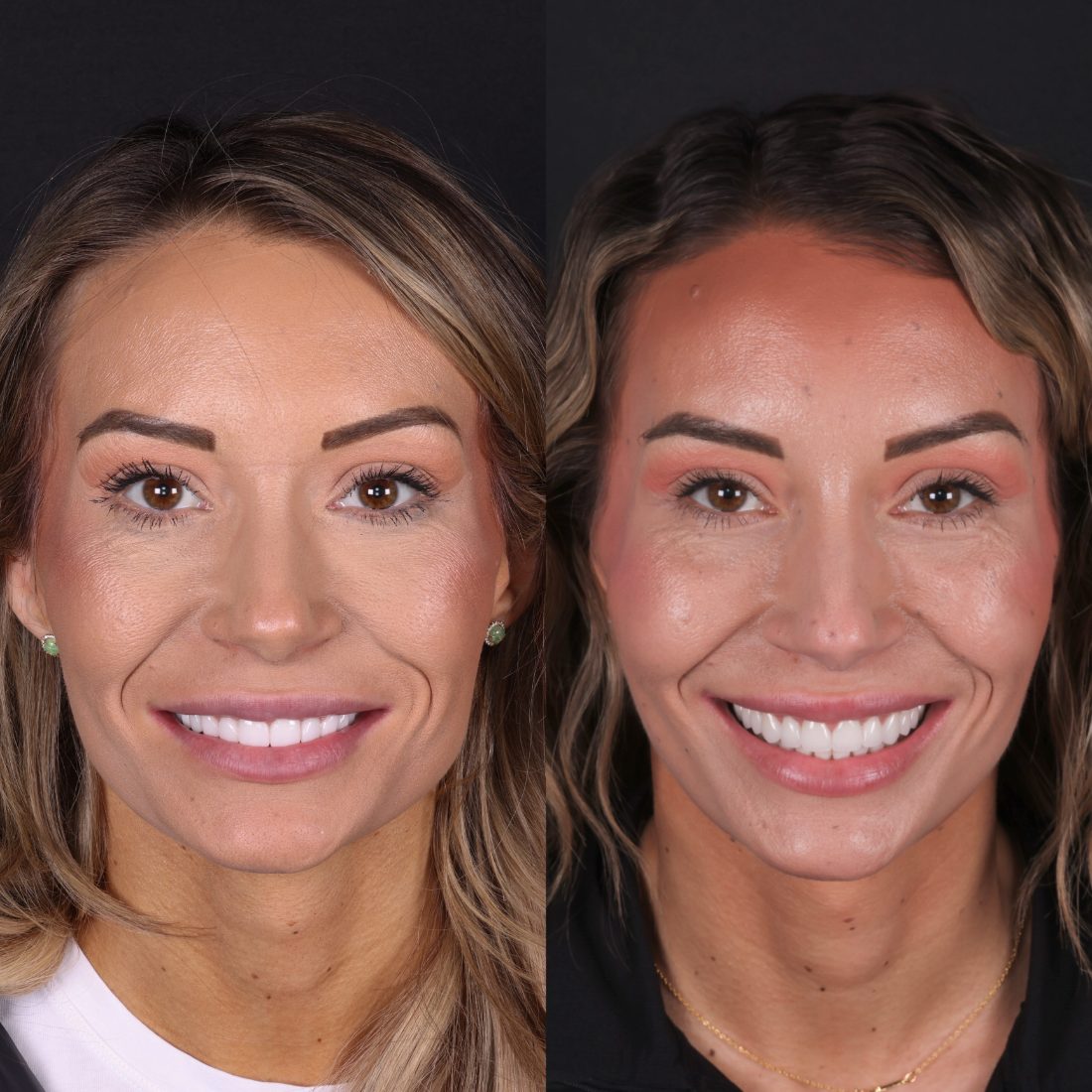 Veneers before and after by Dr. Kooper Ruminer