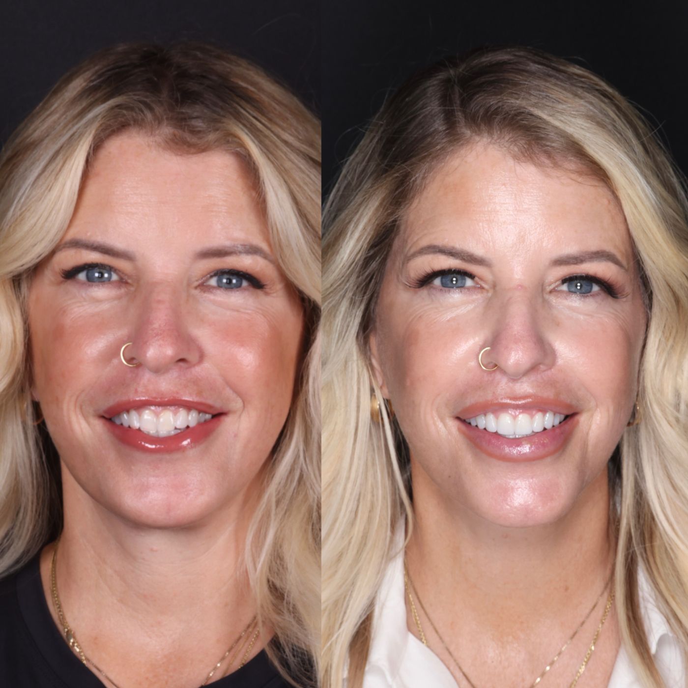 After — smile by Dr. Kooper Ruminer