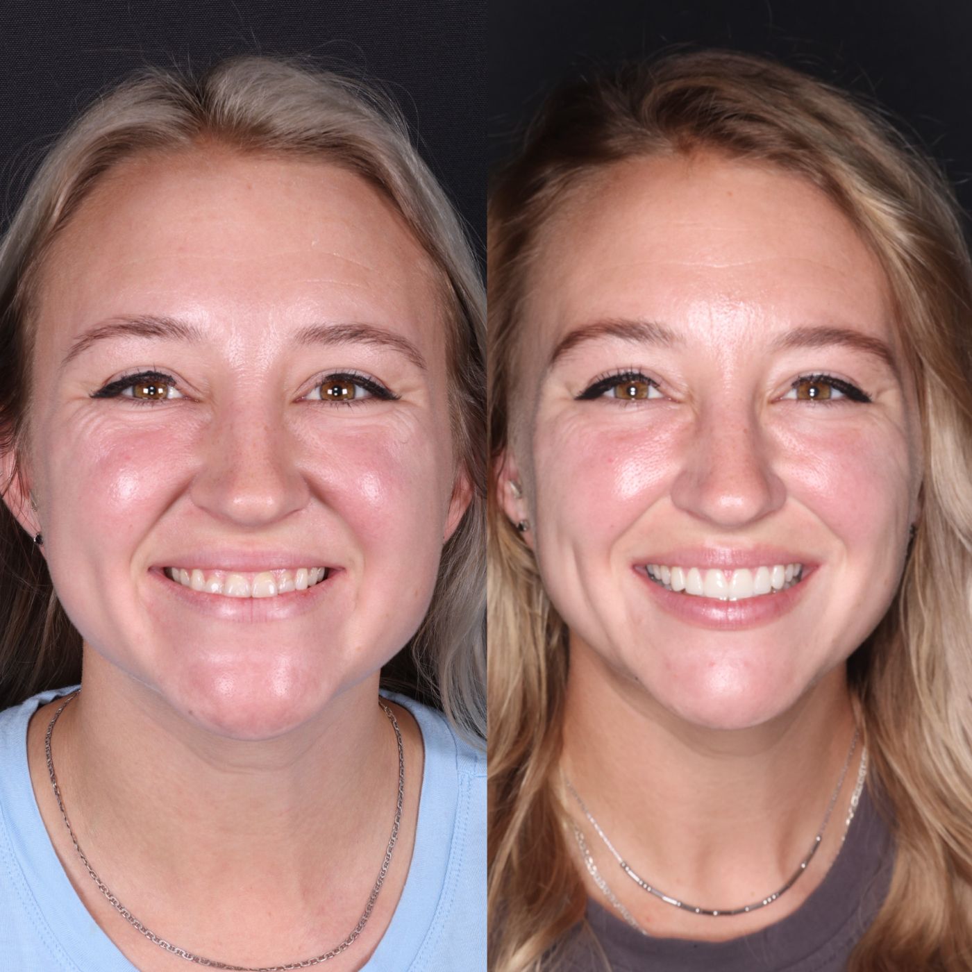 After — smile by Dr. Kooper Ruminer