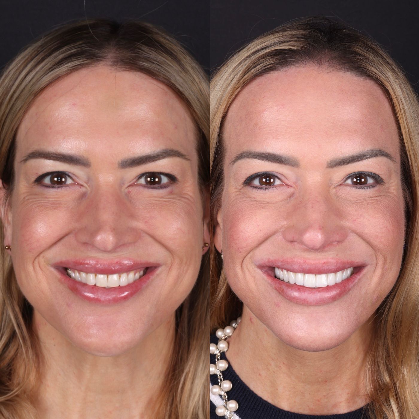 Before — smile by Dr. Kooper Ruminer