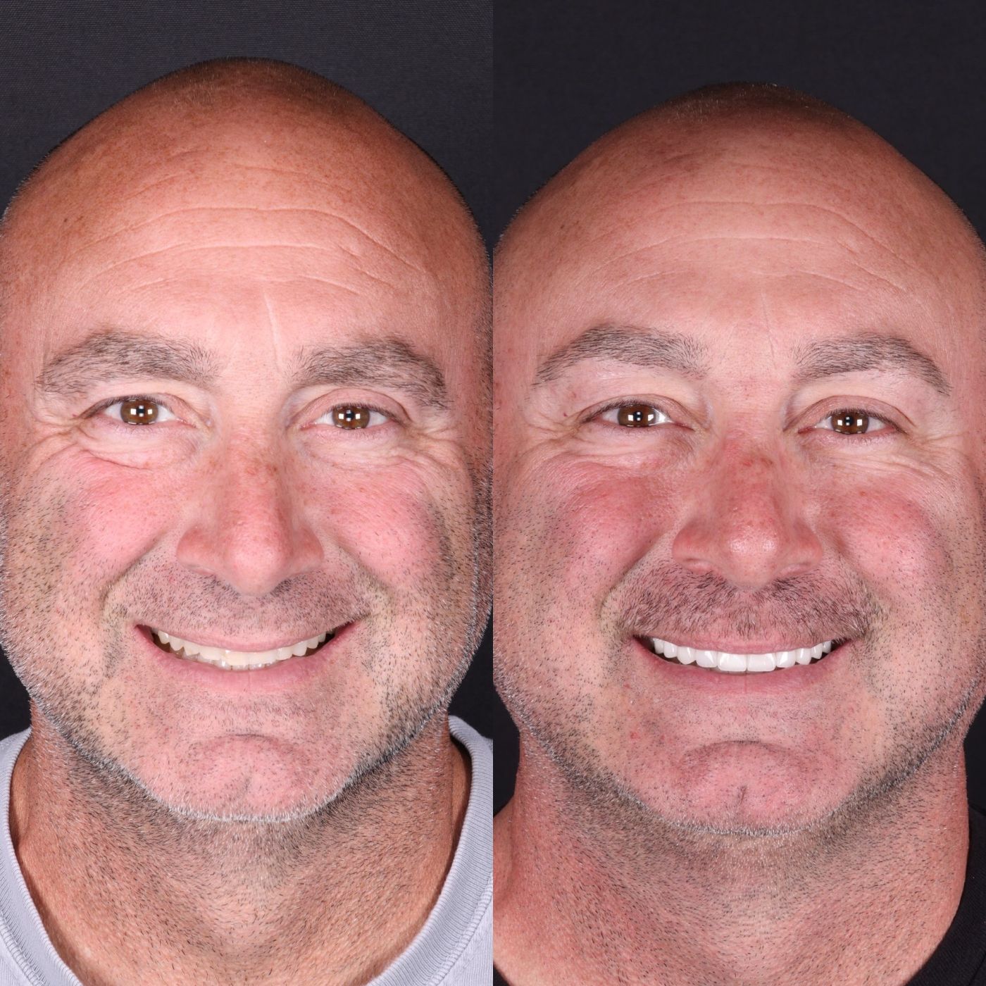 Before — smile by Dr. Kooper Ruminer